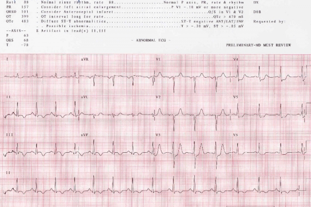 ekg1 ekg1
